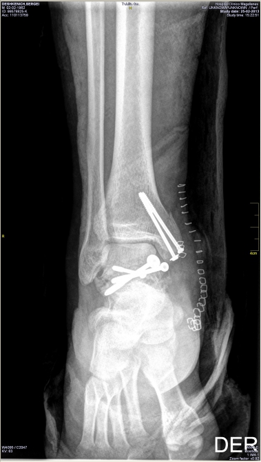 АПять подкралась незаметно (Альпинизм, альпинизм, патагония, торрес дэль пайне. первопроход, cerro escudo, михаил дэви, сергей дашкевич, анатолий ярунов, аркадий серегин)