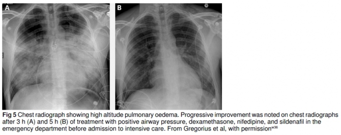 Острая высотная болезнь: обзор по "горняшке" (Альпинизм, высотный отёк лёгких, высотный отёк мозга, острая горная болезнь, акклиматизация, медицина)