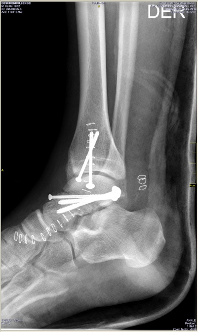 АПять подкралась незаметно (Альпинизм, альпинизм, патагония, торрес дэль пайне. первопроход, cerro escudo, михаил дэви, сергей дашкевич, анатолий ярунов, аркадий серегин)